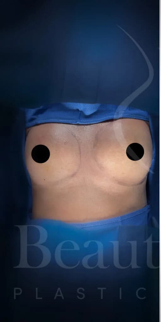 Aumento de senos antes por Dr. Oliver Simmons en Miami · Beautyland Plastic Surgery