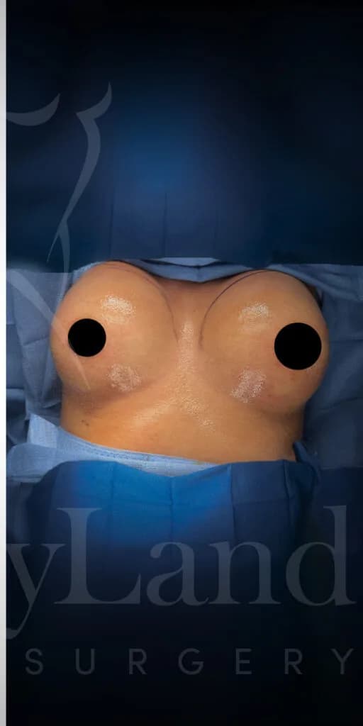 Aumento de senos después por Dr. Oliver Simmons en Miami · Beautyland Plastic Surgery