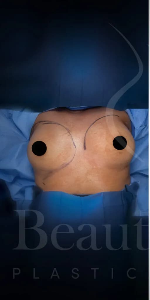 Aumento de senos antes por Dr. Oliver Simmons en Miami · Beautyland Plastic Surgery