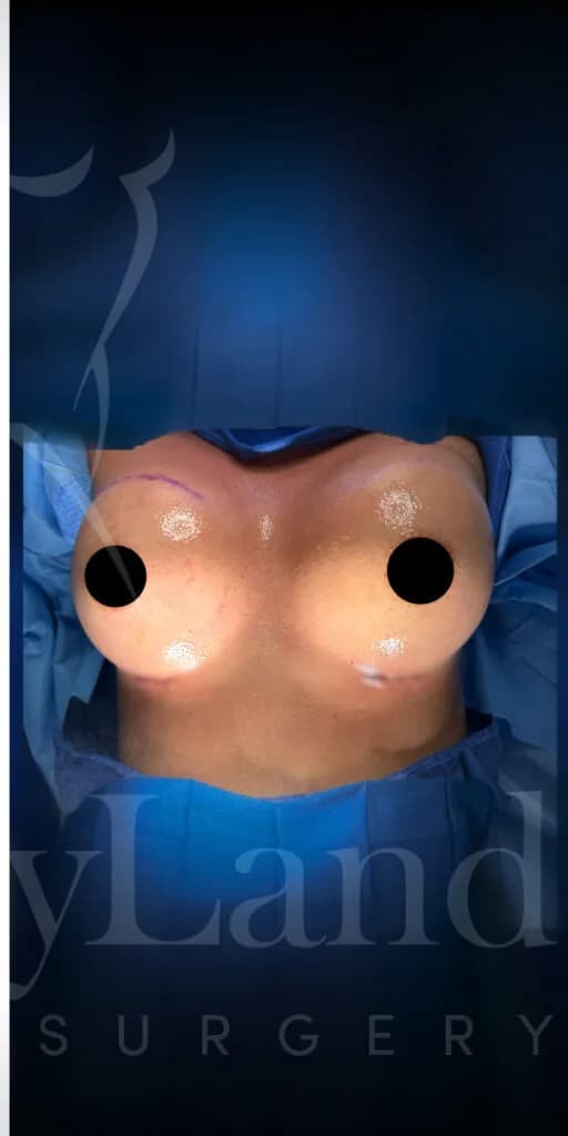 Aumento de senos después por Dr. Oliver Simmons en Miami · Beautyland Plastic Surgery