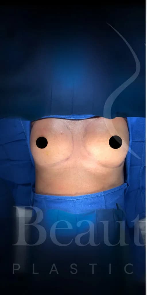 Aumento de senos antes por Dr. Oliver Simmons en Miami · Beautyland Plastic Surgery