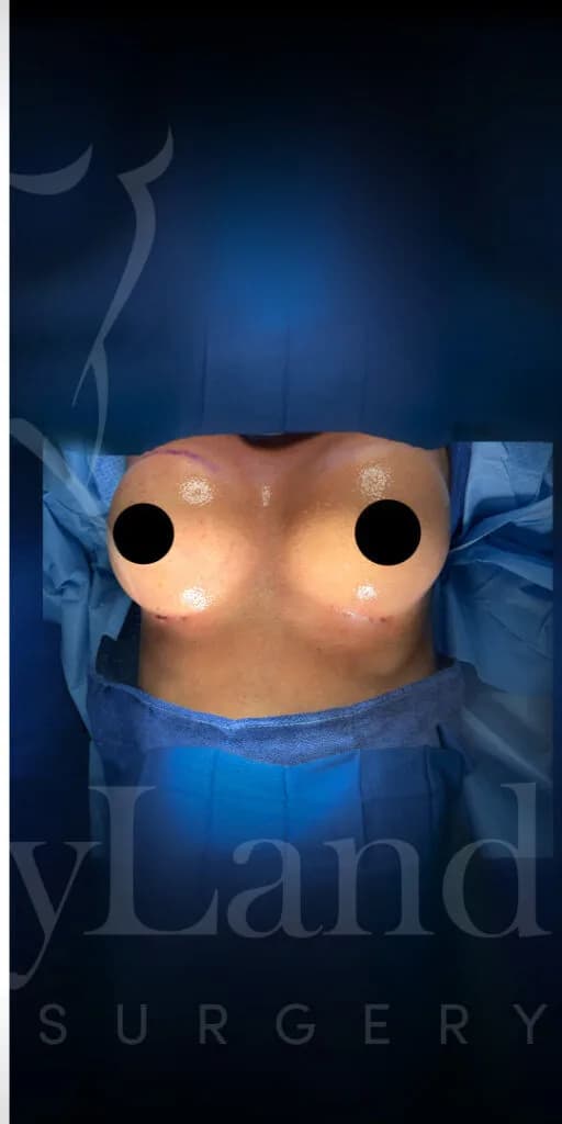 Aumento de senos después por Dr. Oliver Simmons en Miami · Beautyland Plastic Surgery