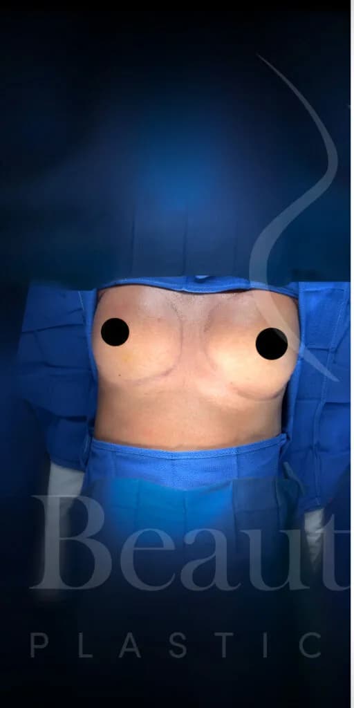 Aumento de senos antes por Dr. Oliver Simmons en Miami · Beautyland Plastic Surgery
