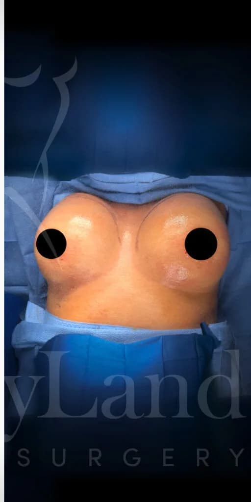 Aumento de senos después por Dr. Oliver Simmons en Miami · Beautyland Plastic Surgery