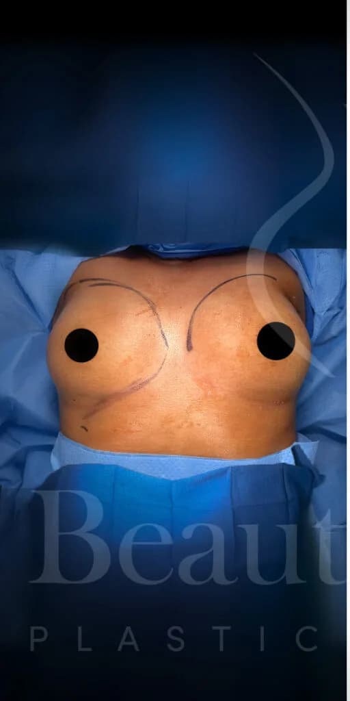 Aumento de senos antes por Dr. Oliver Simmons en Miami · Beautyland Plastic Surgery
