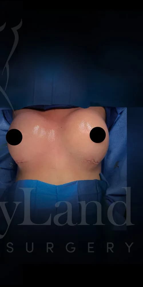 Aumento de senos después por Dr. Oliver Simmons en Miami · Beautyland Plastic Surgery