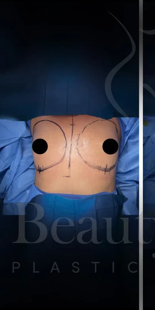 Aumento de senos antes por Dr. Oliver Simmons en Miami · Beautyland Plastic Surgery