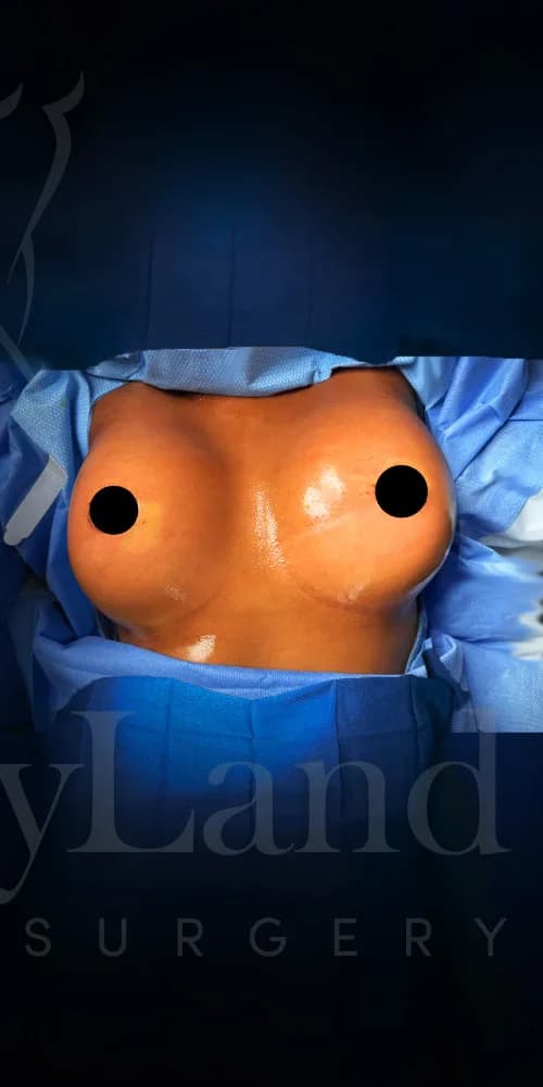 Aumento de senos después por Dr. Oliver Simmons en Miami · Beautyland Plastic Surgery
