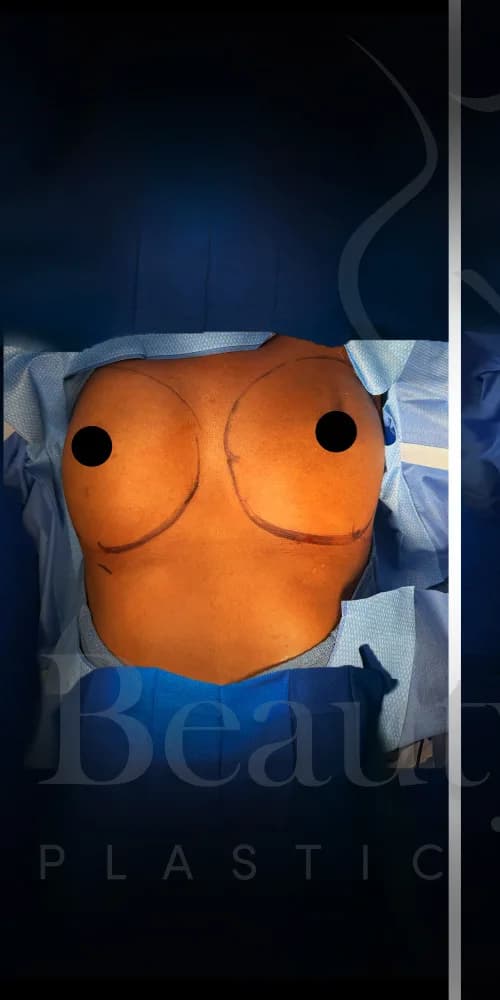 Aumento de senos antes por Dr. Oliver Simmons en Miami · Beautyland Plastic Surgery