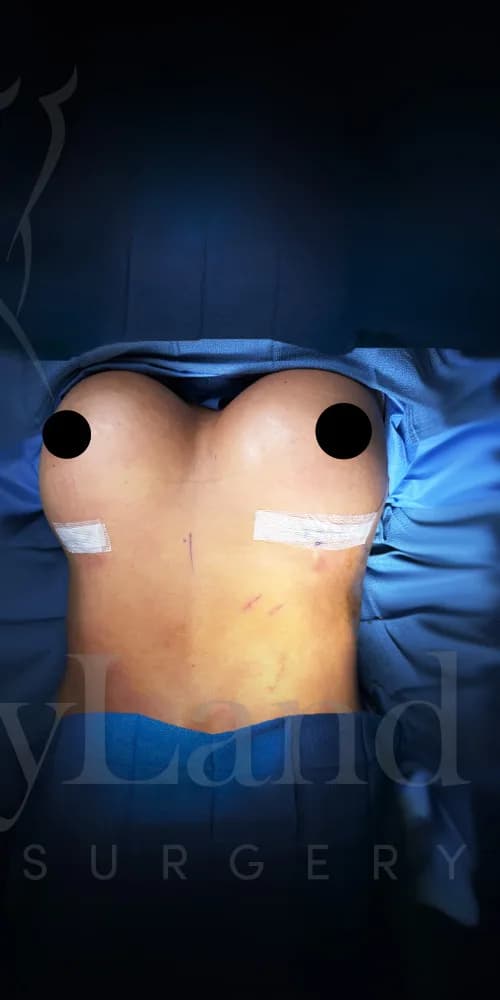 Aumento de senos después por Dr. Oliver Simmons en Miami · Beautyland Plastic Surgery
