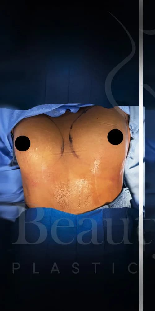Aumento de senos antes por Dr. Oliver Simmons en Miami · Beautyland Plastic Surgery