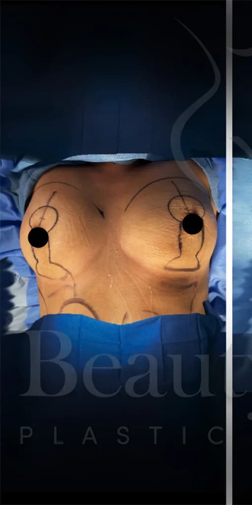 Aumento de senos antes por Dr. Oliver Simmons en Miami · Beautyland Plastic Surgery