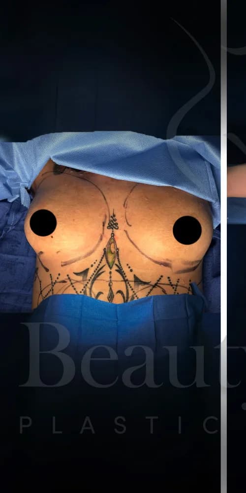 Aumento de senos antes por Dr. Oliver Simmons en Miami · Beautyland Plastic Surgery