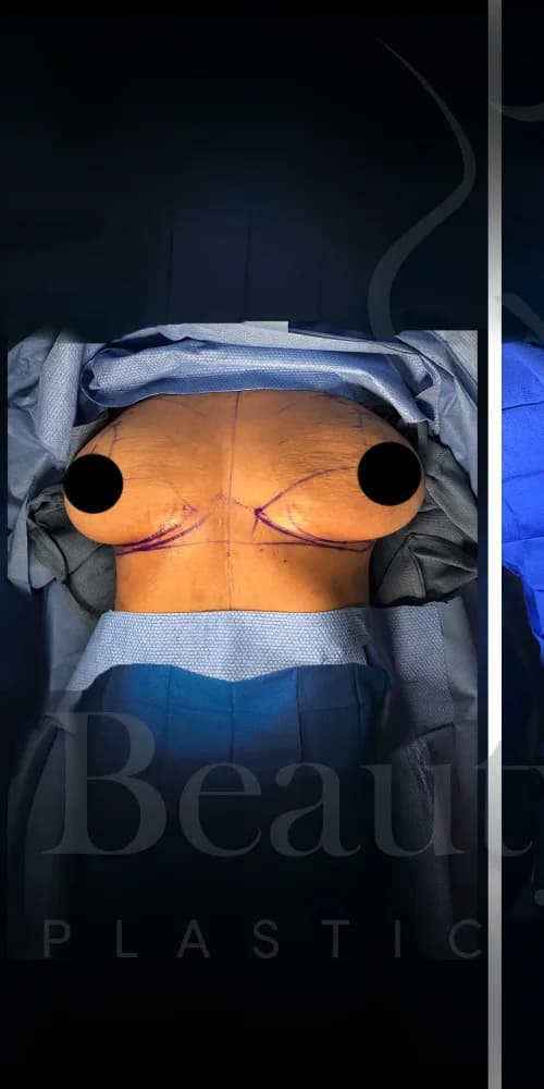 Mastopexia (elevación de senos) antes por Dr. Anne-Sophie Lessard en Miami · Beautyland Plastic Surgery
