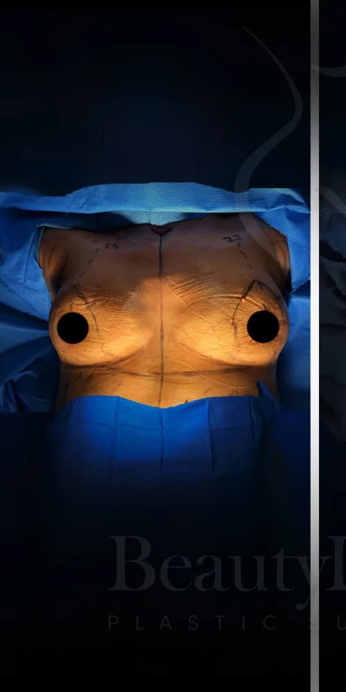 Mastopexia (elevación de senos) antes por Dr. Anne-Sophie Lessard en Miami · Beautyland Plastic Surgery