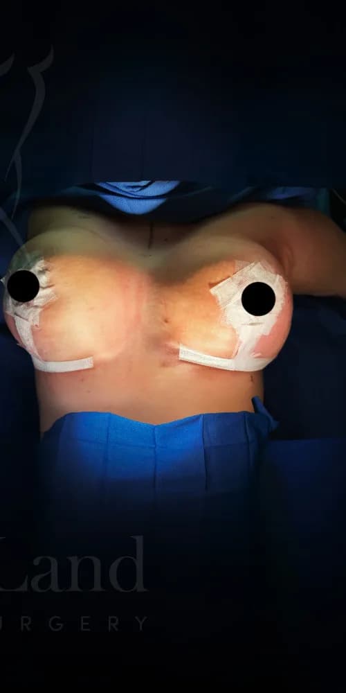 Mastopexia (elevación de senos) después por Dr. Anne-Sophie Lessard en Miami · Beautyland Plastic Surgery