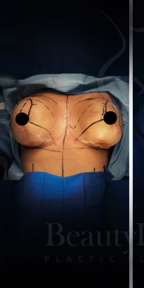 Mastopexia (elevación de senos) antes por Dr. Anne-Sophie Lessard en Miami · Beautyland Plastic Surgery