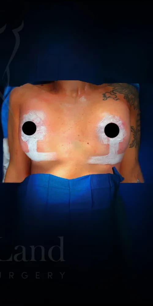 Mastopexia (elevación de senos) después por Dr. Anne-Sophie Lessard en Miami · Beautyland Plastic Surgery