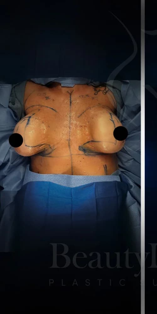 Mastopexia (elevación de senos) antes por Dr. Anne-Sophie Lessard en Miami · Beautyland Plastic Surgery