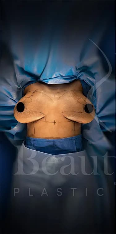 Mastopexia (elevación de senos) antes por Dr. Oliver Simmons en Miami · Beautyland Plastic Surgery