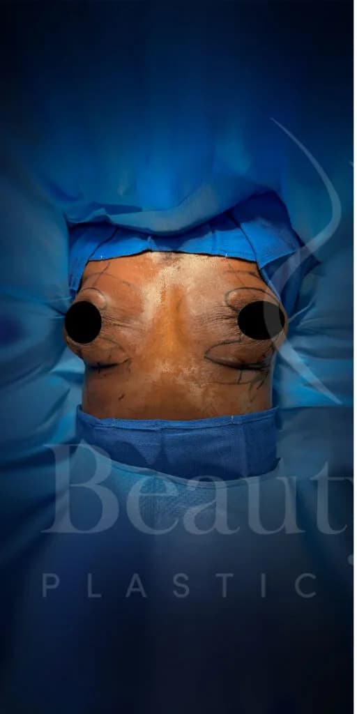 Mastopexia (elevación de senos) antes por Dr. Oliver Simmons en Miami · Beautyland Plastic Surgery