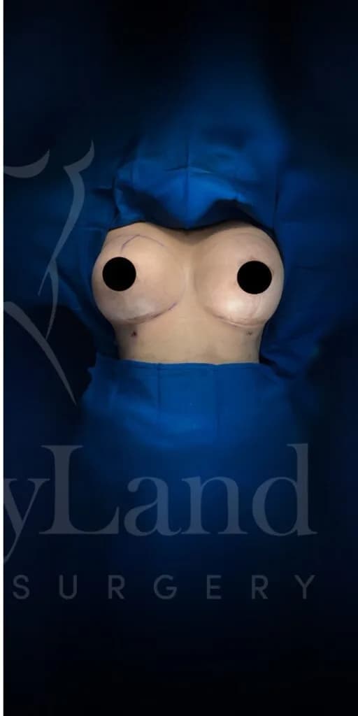 Mastopexia (elevación de senos) después por Dr. Oliver Simmons en Miami · Beautyland Plastic Surgery