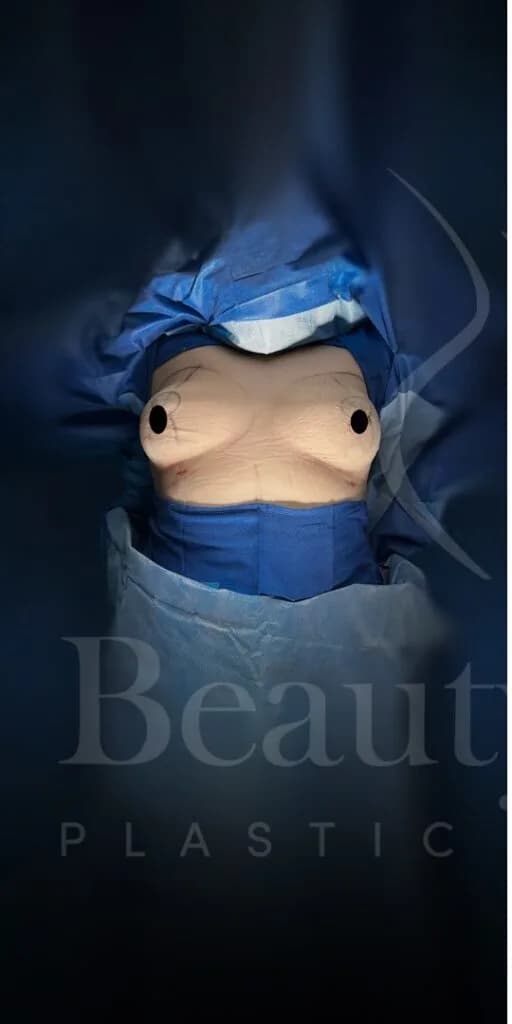Mastopexia (elevación de senos) antes por Dr. Oliver Simmons en Miami · Beautyland Plastic Surgery