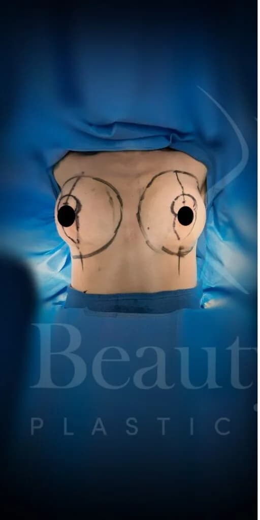 Mastopexia (elevación de senos) antes por Dr. Oliver Simmons en Miami · Beautyland Plastic Surgery