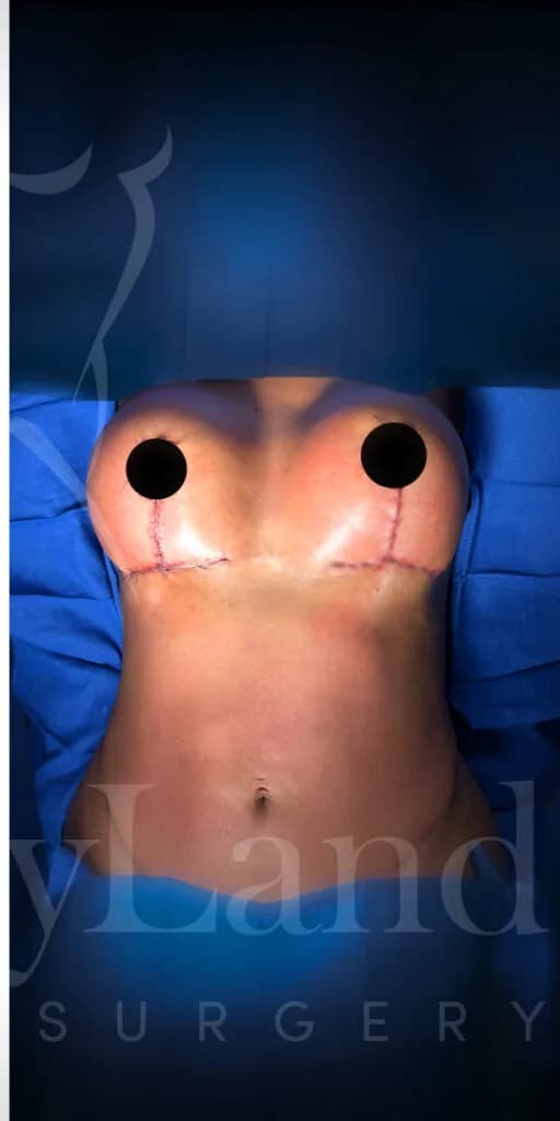 Mastopexia (elevación de senos) después por Dr. Oliver Simmons en Miami · Beautyland Plastic Surgery