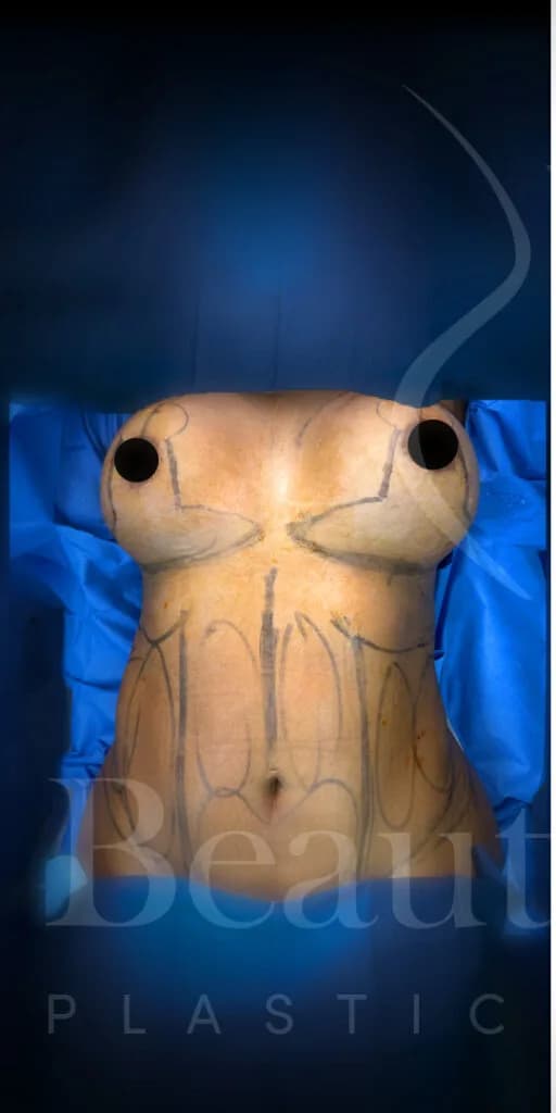Mastopexia (elevación de senos) antes por Dr. Oliver Simmons en Miami · Beautyland Plastic Surgery