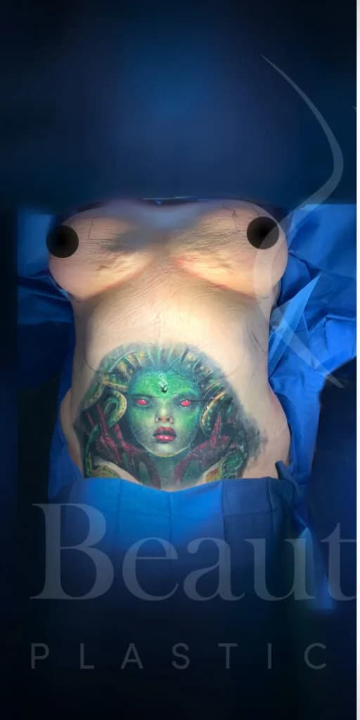 Mastopexia (elevación de senos) antes por Dr. Oliver Simmons en Miami · Beautyland Plastic Surgery
