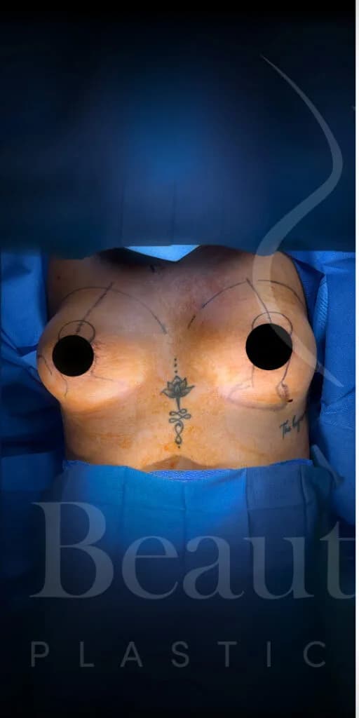 Mastopexia (elevación de senos) antes por Dr. Oliver Simmons en Miami · Beautyland Plastic Surgery