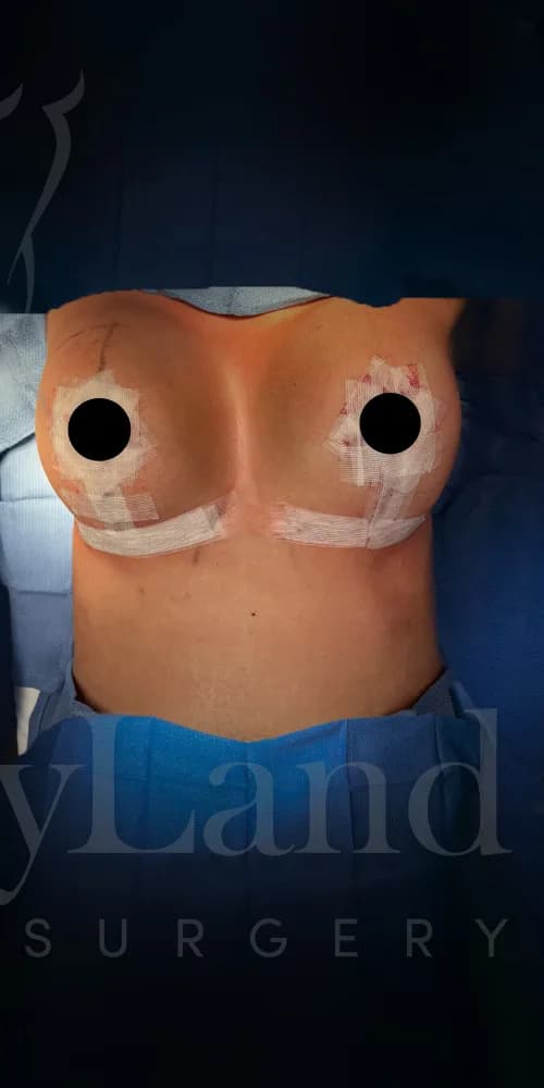 Mastopexia (elevación de senos) después por Dr. Oliver Simmons en Miami · Beautyland Plastic Surgery