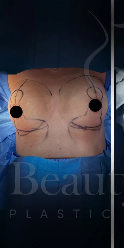 Mastopexia (elevación de senos) antes por Dr. Oliver Simmons en Miami · Beautyland Plastic Surgery