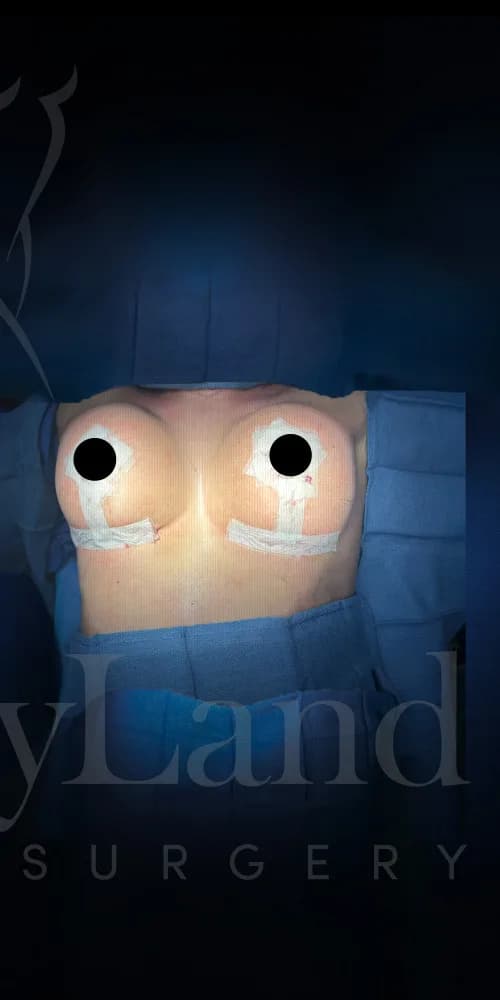 Mastopexia (elevación de senos) después por Dr. Oliver Simmons en Miami · Beautyland Plastic Surgery