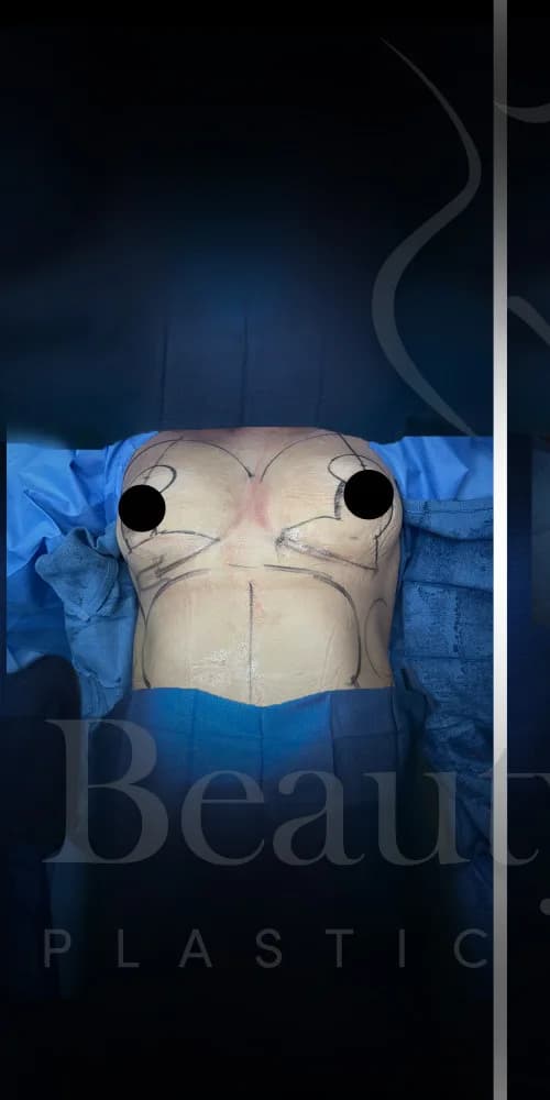 Mastopexia (elevación de senos) antes por Dr. Oliver Simmons en Miami · Beautyland Plastic Surgery