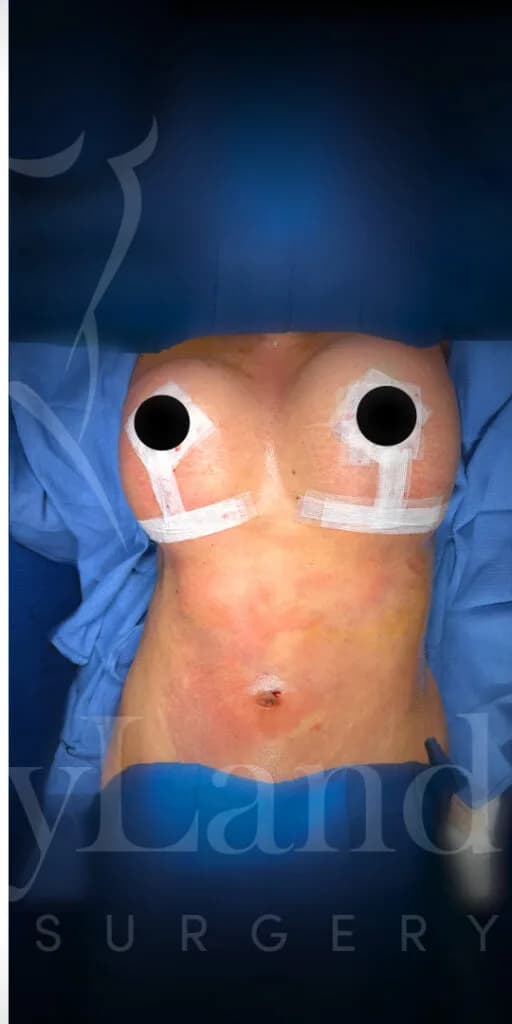 Mastopexia (elevación de senos) después por Dr. Oliver Simmons en Miami · Beautyland Plastic Surgery