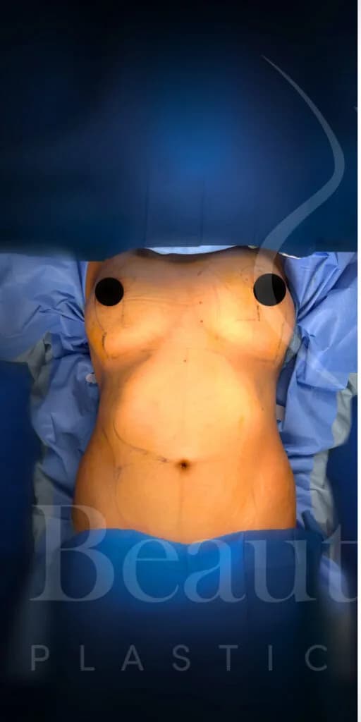 Mastopexia (elevación de senos) antes por Dr. Oliver Simmons en Miami · Beautyland Plastic Surgery
