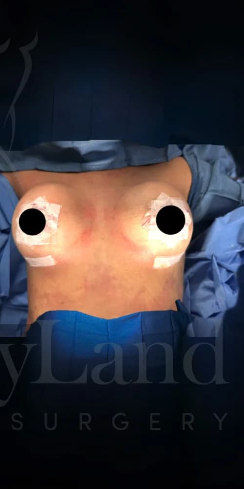 Mastopexia (elevación de senos) después por Dr. Oliver Simmons en Miami · Beautyland Plastic Surgery