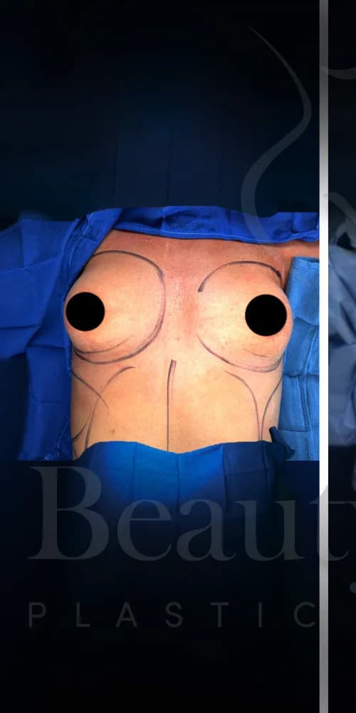 Mastopexia (elevación de senos) antes por Dr. Oliver Simmons en Miami · Beautyland Plastic Surgery