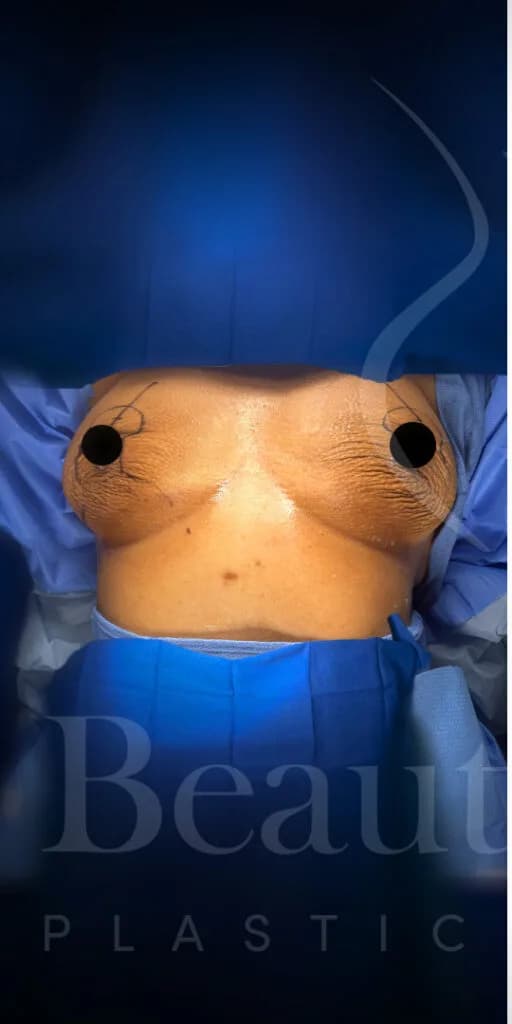 Mastopexia (elevación de senos) antes por Dr. Oliver Simmons en Miami · Beautyland Plastic Surgery