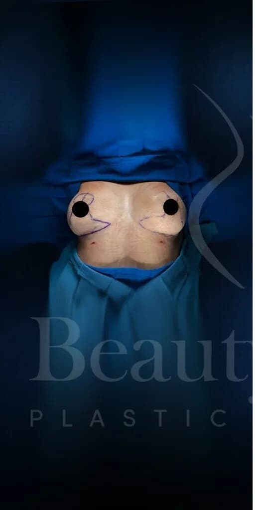 Mastopexia (elevación de senos) antes por Dr. Oliver Simmons en Miami · Beautyland Plastic Surgery