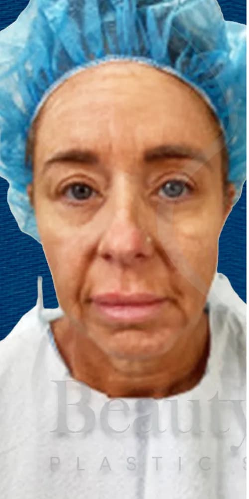Lifting facial antes por Dr. Oliver Simmons en Miami · Beautyland Plastic Surgery