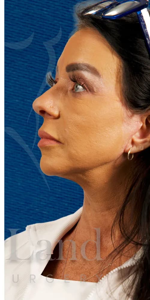 Lifting facial después por Dr. Oliver Simmons en Miami · Beautyland Plastic Surgery