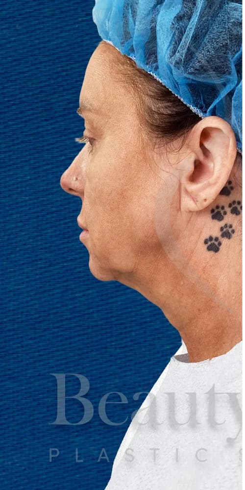 Lifting facial antes por Dr. Oliver Simmons en Miami · Beautyland Plastic Surgery