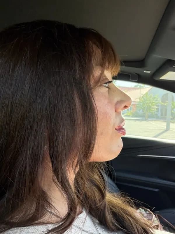 Rhinoplasty after by Dr. Oliver Simmons in Miami · Beautyland Plastic Surgery