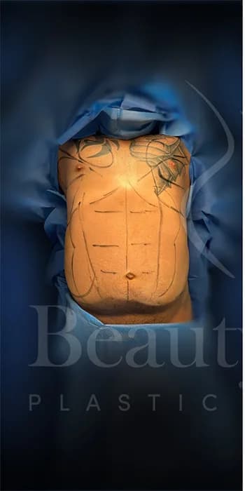 Liposucción y Lipo 360 antes por Dr. Oliver Simmons en Miami · Beautyland Plastic Surgery