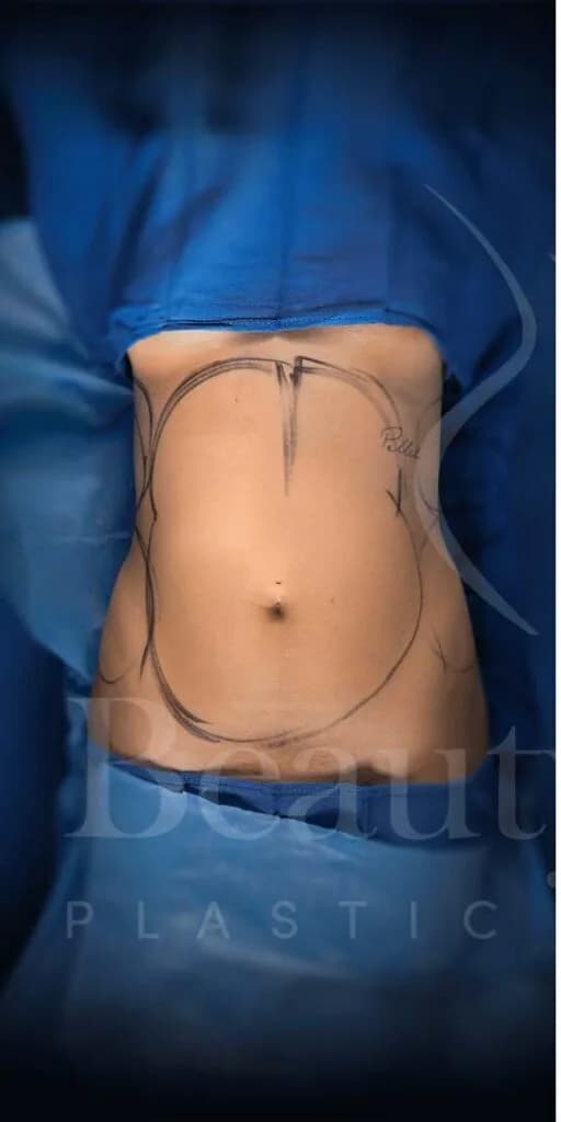 Liposucción y Lipo 360 antes por Dr. Oliver Simmons en Miami · Beautyland Plastic Surgery