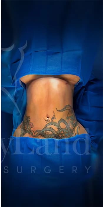 Liposucción y Lipo 360 después por Dr. Oliver Simmons en Miami · Beautyland Plastic Surgery