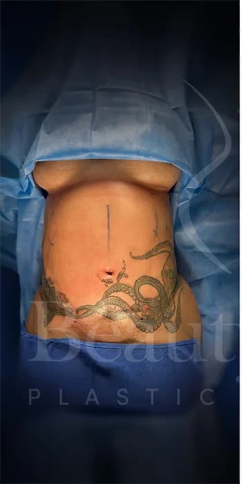 Liposucción y Lipo 360 antes por Dr. Oliver Simmons en Miami · Beautyland Plastic Surgery